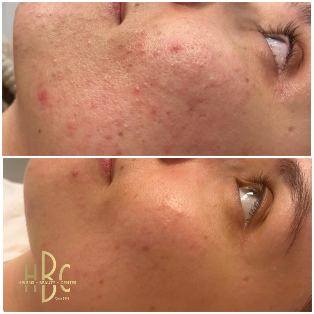 Före och efter Dermapen 4-behandling av aknemärken och ojämn hudstruktur på kinden hos HBC i Borås. Före överst, efter underst.