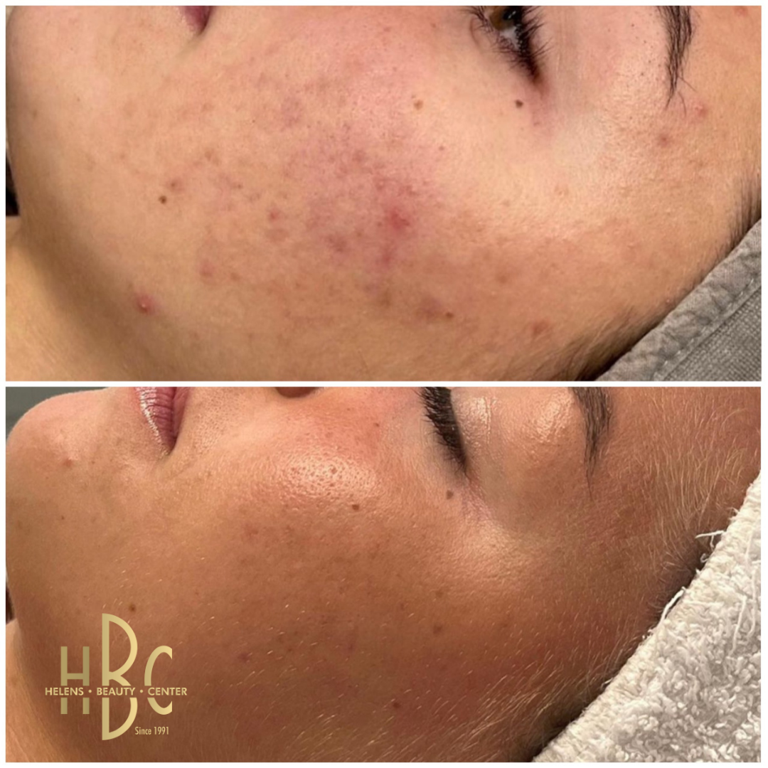Före och efter Dermapen 4-behandling av aknemärken och ojämn hudstruktur på kind och käklinje hos HBC i Borås. Före överst, efter underst.