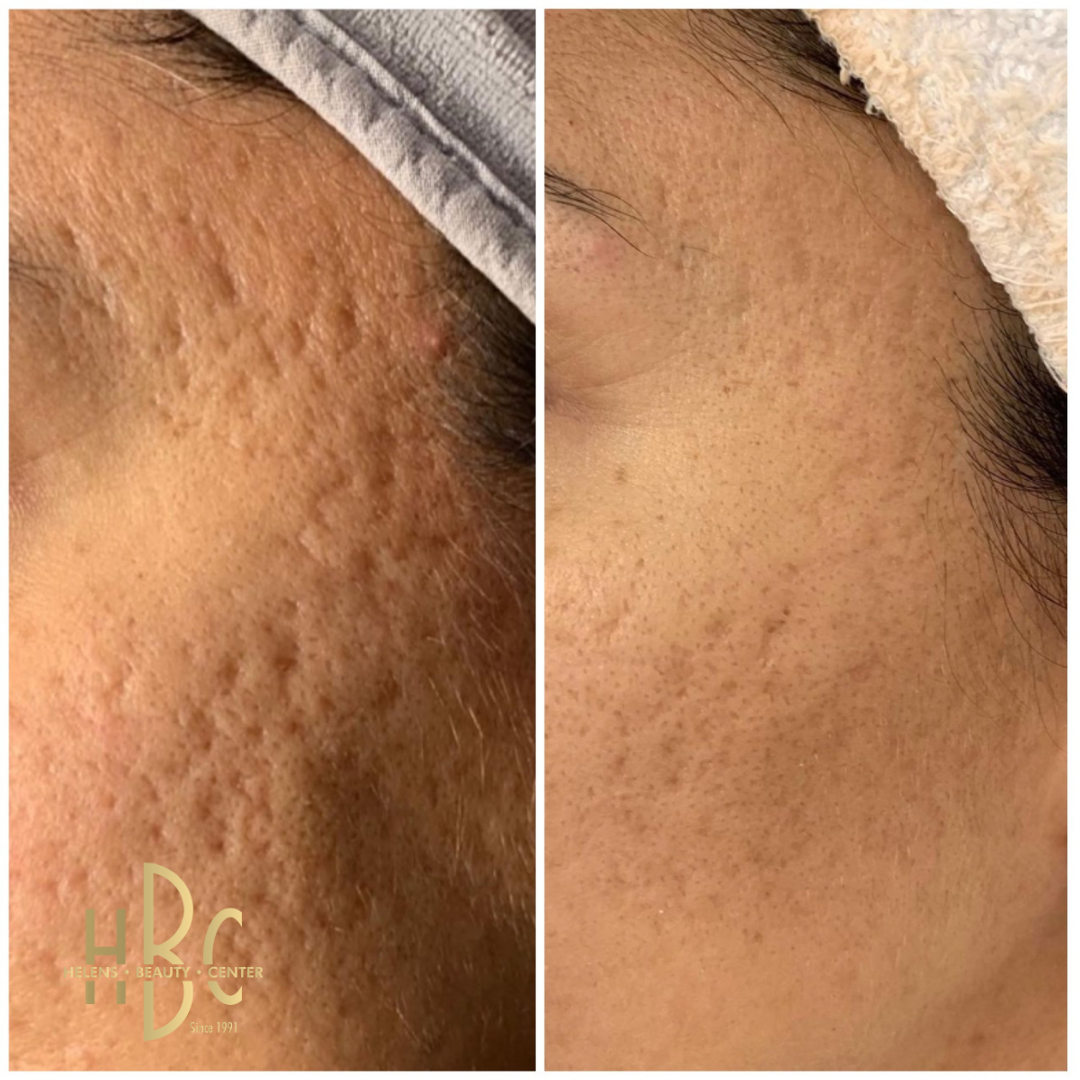 Före och efter Dermapen 4-behandling av akneärr och ojämn hudstruktur på kinden hos HBC i Borås. Före till vänster, efter till höger.