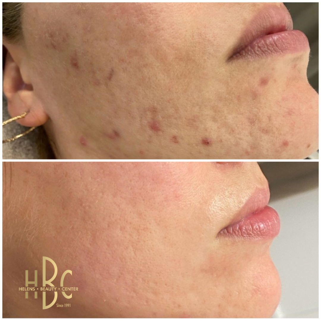 Före och efter Dermapen 4-behandling av aknemärken och ojämn hudstruktur på kind och käklinje hos HBC i Borås. Före överst, efter underst.