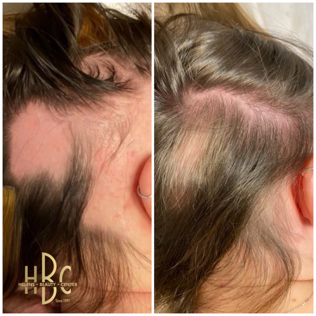 Före och efter behandling med DR CYJ Hair Filler hos HBC i Borås: hårfäste vid tinningen med tunnare hår. Före till vänster, efter till höger.