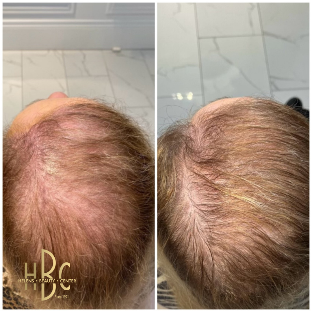 Före och efter behandling med DR CYJ Hair Filler hos HBC i Borås: hjässa med gles hårväxt. Före till vänster, efter till höger.