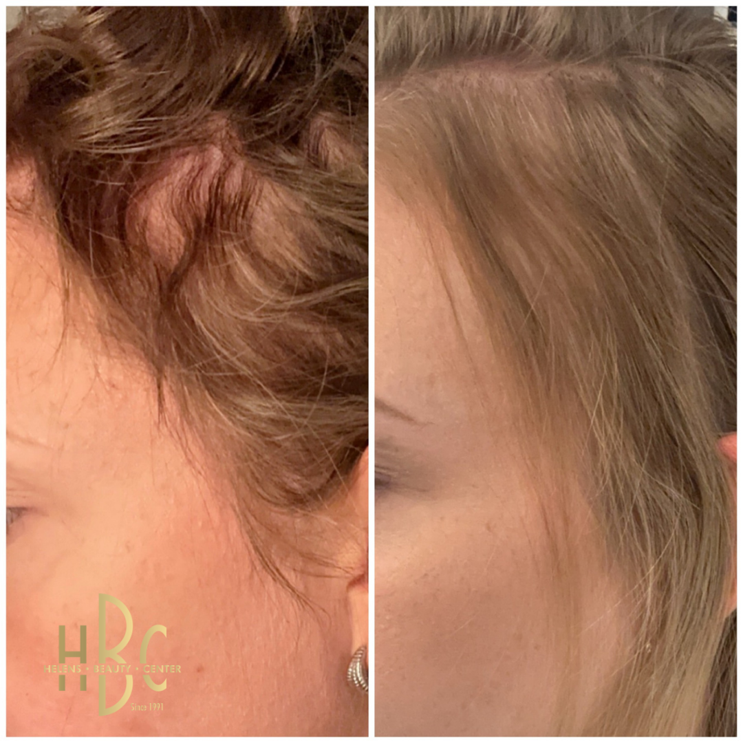 Före och efter behandling med DR CYJ Hair Filler hos HBC i Borås: hårfäste och tinning med tunnare hår. Före till vänster, efter till höger.