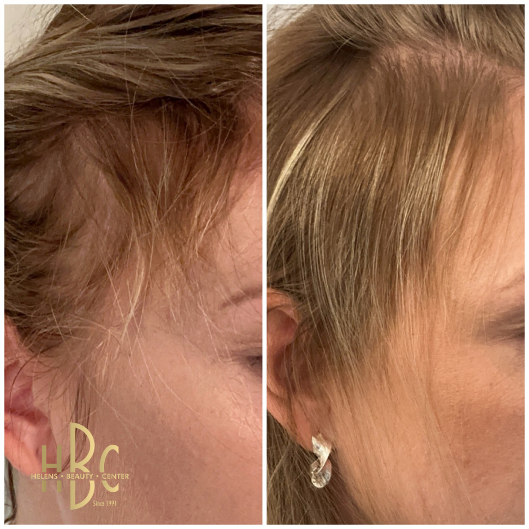Före och efter behandling med DR CYJ Hair Filler hos HBC i Borås: hårfäste vid tinningen. Före till vänster, efter till höger.
