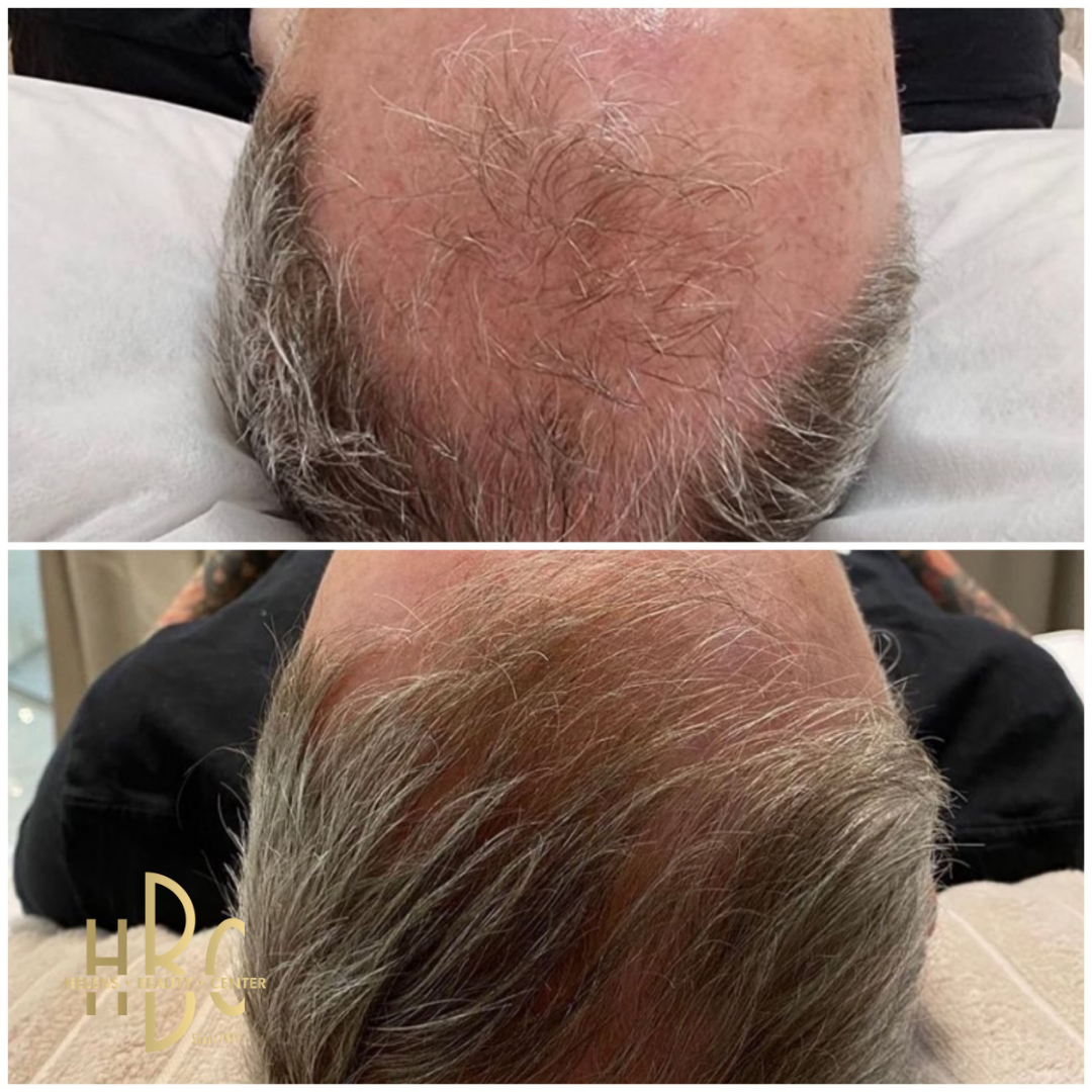 Före och efter behandling med DR CYJ Hair Filler hos HBC i Borås: hjässa med gles hårväxt. Före överst, efter underst.