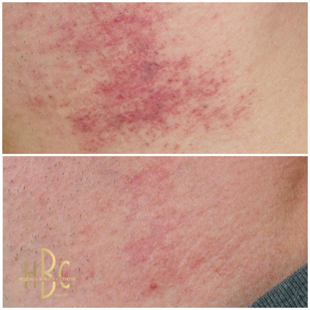 Före och efter IPL-behandling av rodnad och ytliga kärl på kinden hos HBC i Borås. Överst före behandling, underst efter.