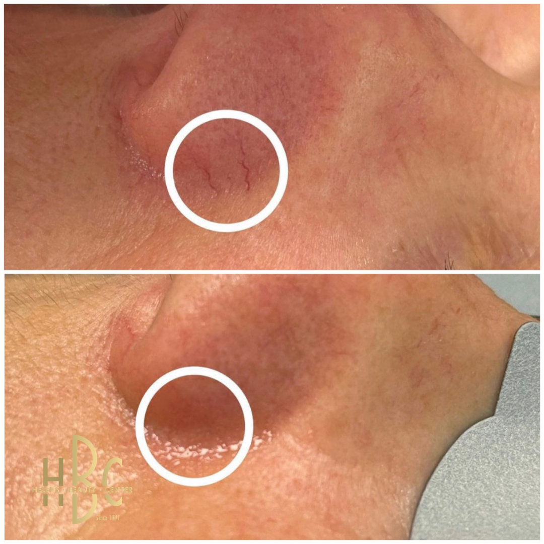 Före och efter IPL-behandling av ett ytligt kärl vid näsvingen hos HBC i Borås, markerat med en vit ring. Överst före behandling, underst efter.