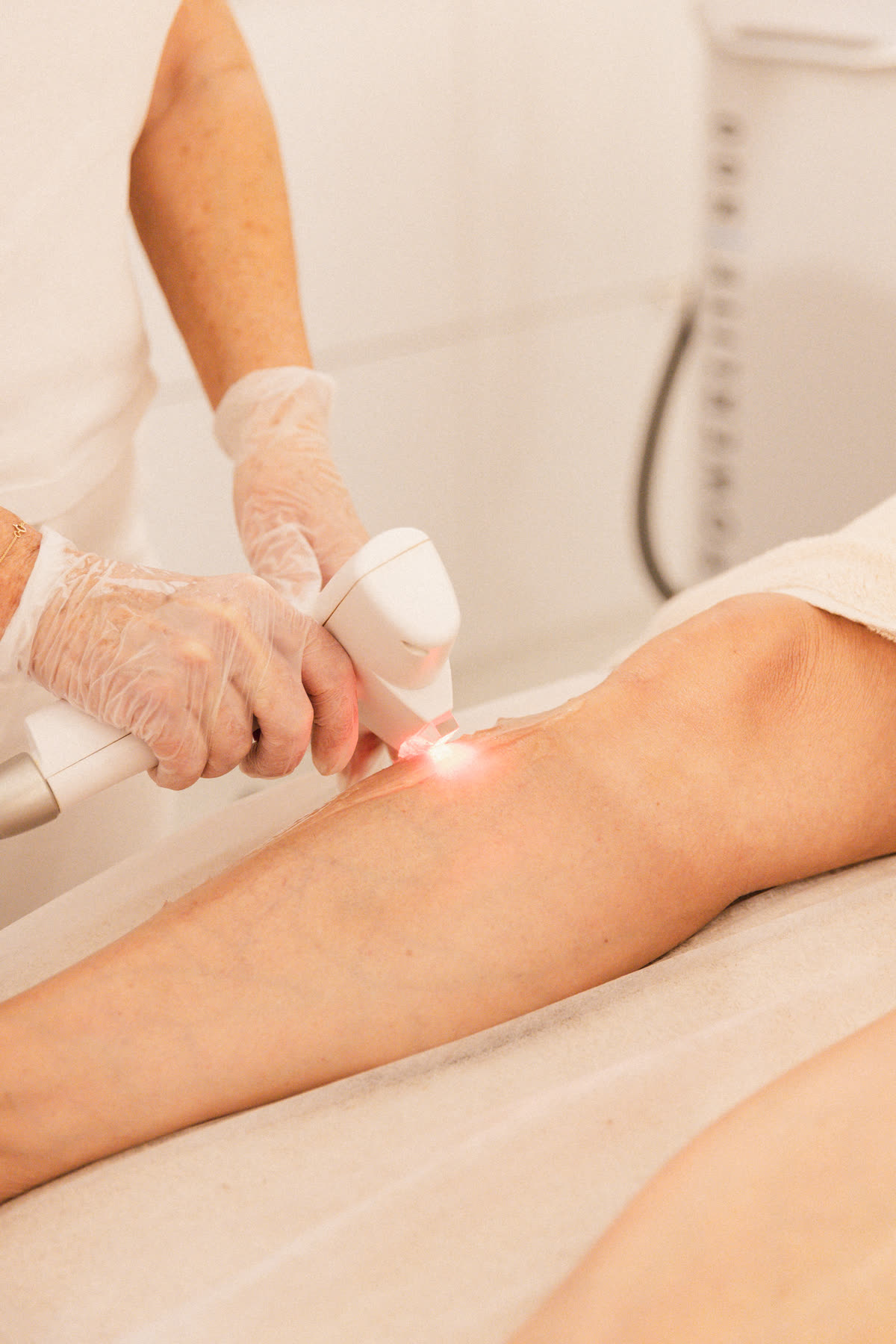 Permanent hårborttagning med IPL på HBC i Borås