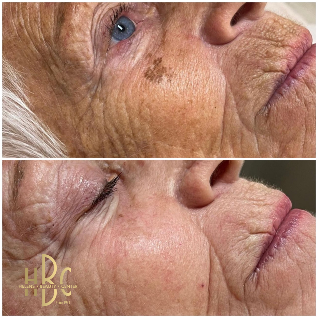 Före och efter kemisk peeling hos HBC i Borås: kind och ögonområde med solfläckar och fina linjer. Före överst, efter underst.