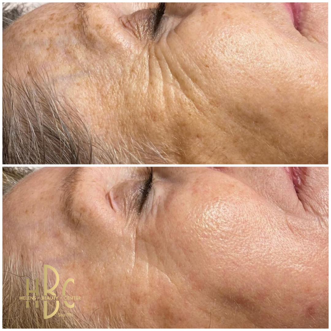 Före och efter kemisk peeling hos HBC i Borås: kind med pigmentfläckar och fina linjer. Före överst, efter underst.