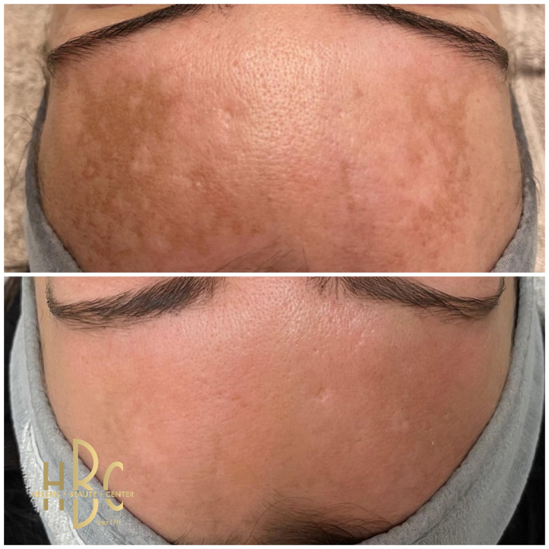 Före och efter kemisk peeling hos HBC i Borås: panna med melasma och ojämn hudton. Före överst, efter underst.
