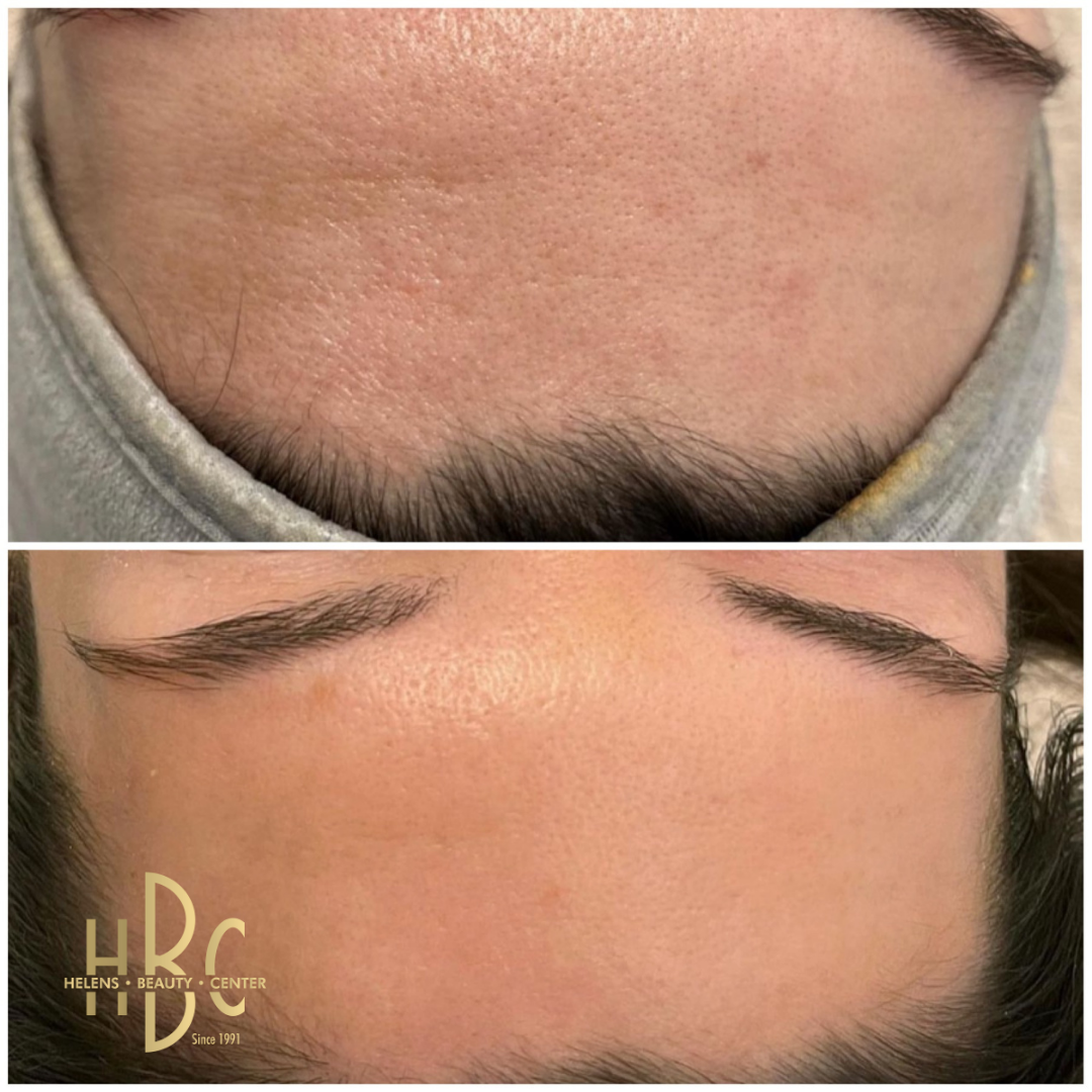 Före och efter kemisk peeling hos HBC i Borås: panna med ojämn hudton. Före överst, efter underst.