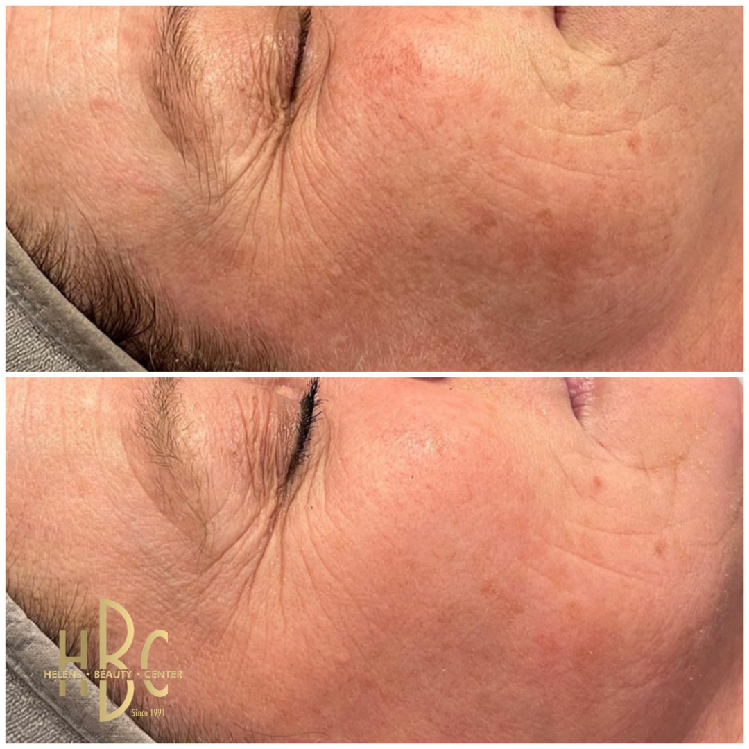 Före och efter kemisk peeling hos HBC i Borås: kind och ögonområde med fina linjer och ojämn hudton. Före överst, efter underst.