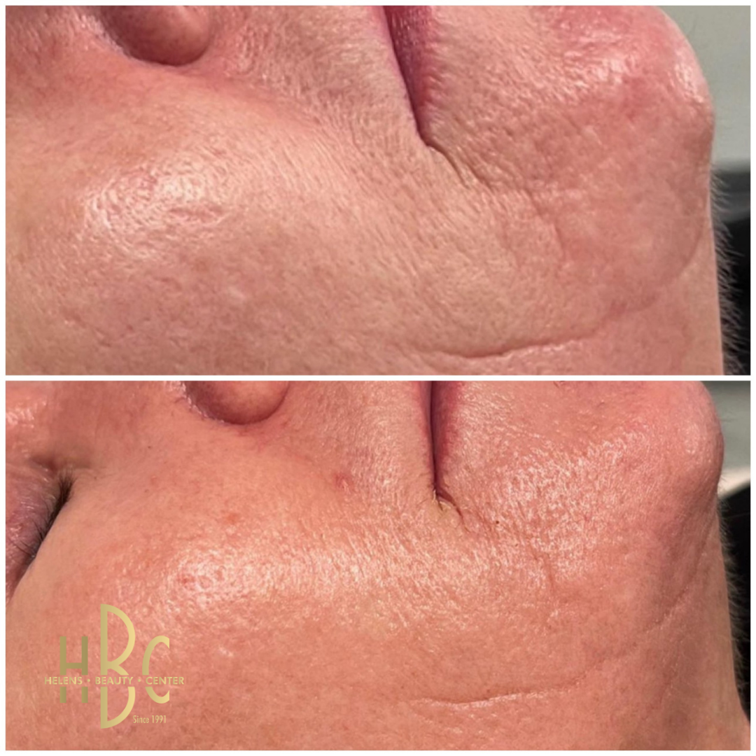 Före och efter kemisk peeling hos HBC i Borås: kind med akneärr och ojämn hudstruktur. Före överst, efter underst.