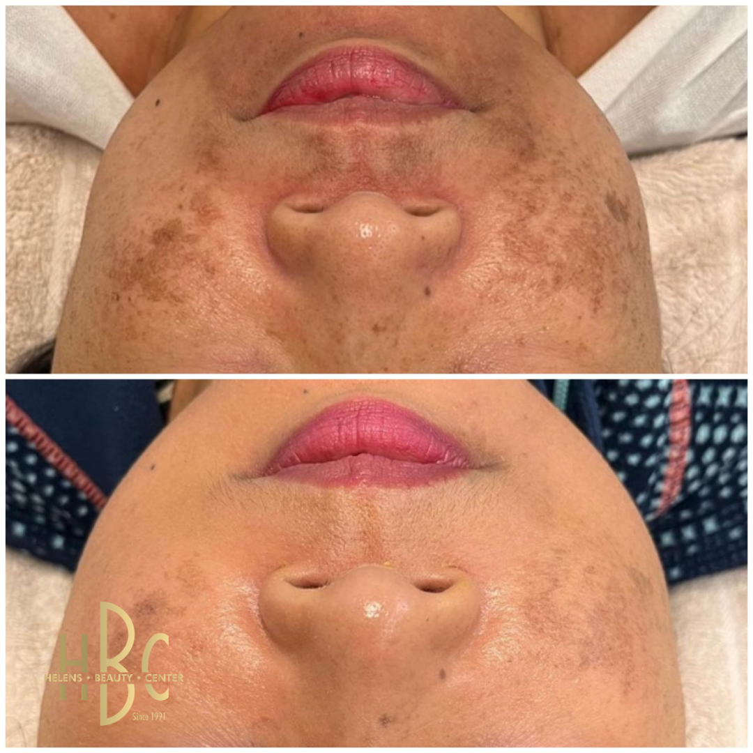 Före och efter kemisk peeling hos HBC i Borås: överläpp och kinder med melasma. Före överst, efter underst.
